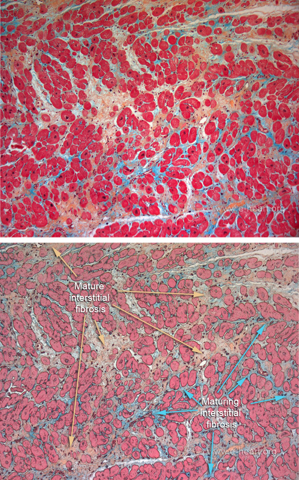 Interstitial Fibrosis Movat stain